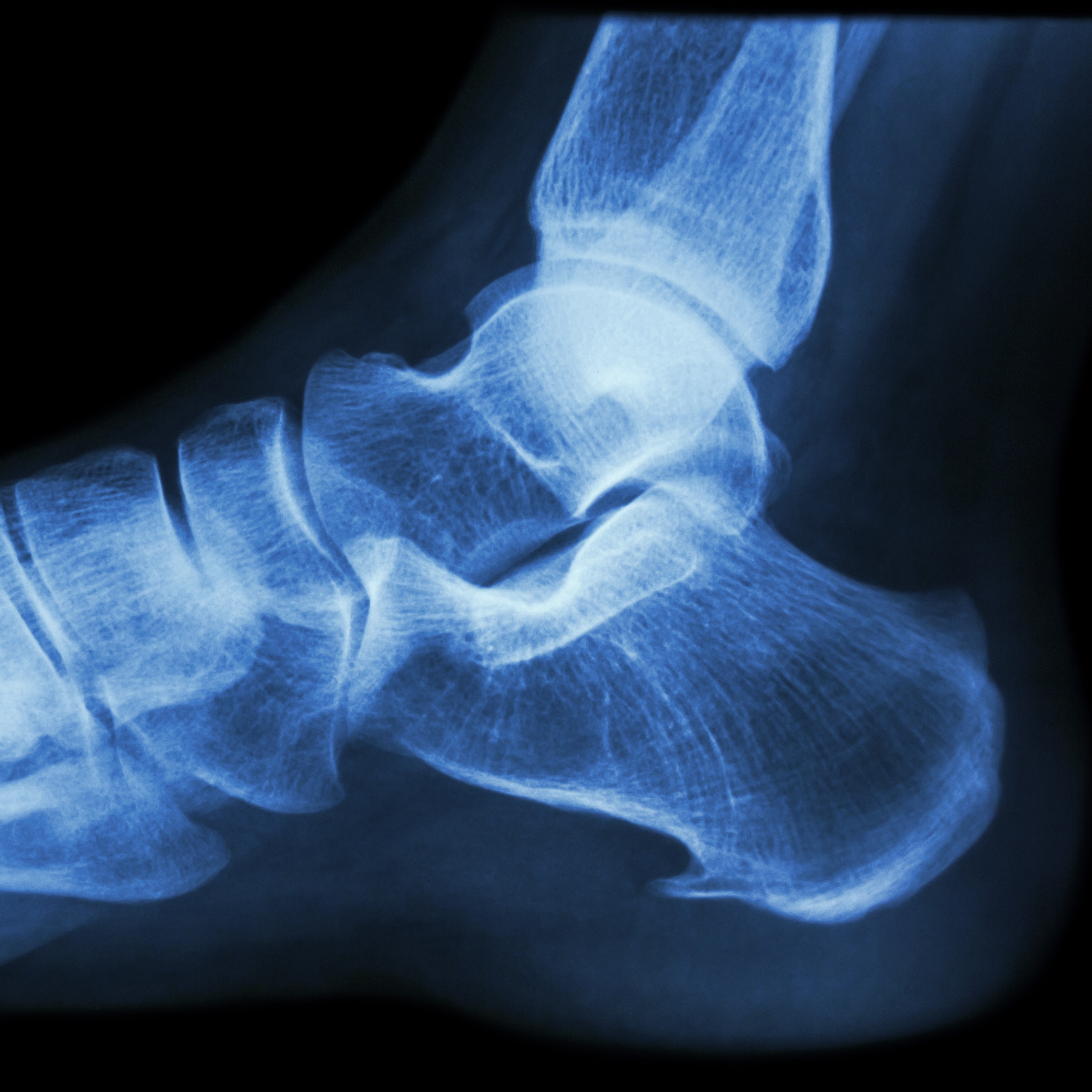 Radiographie d'un talon du pied