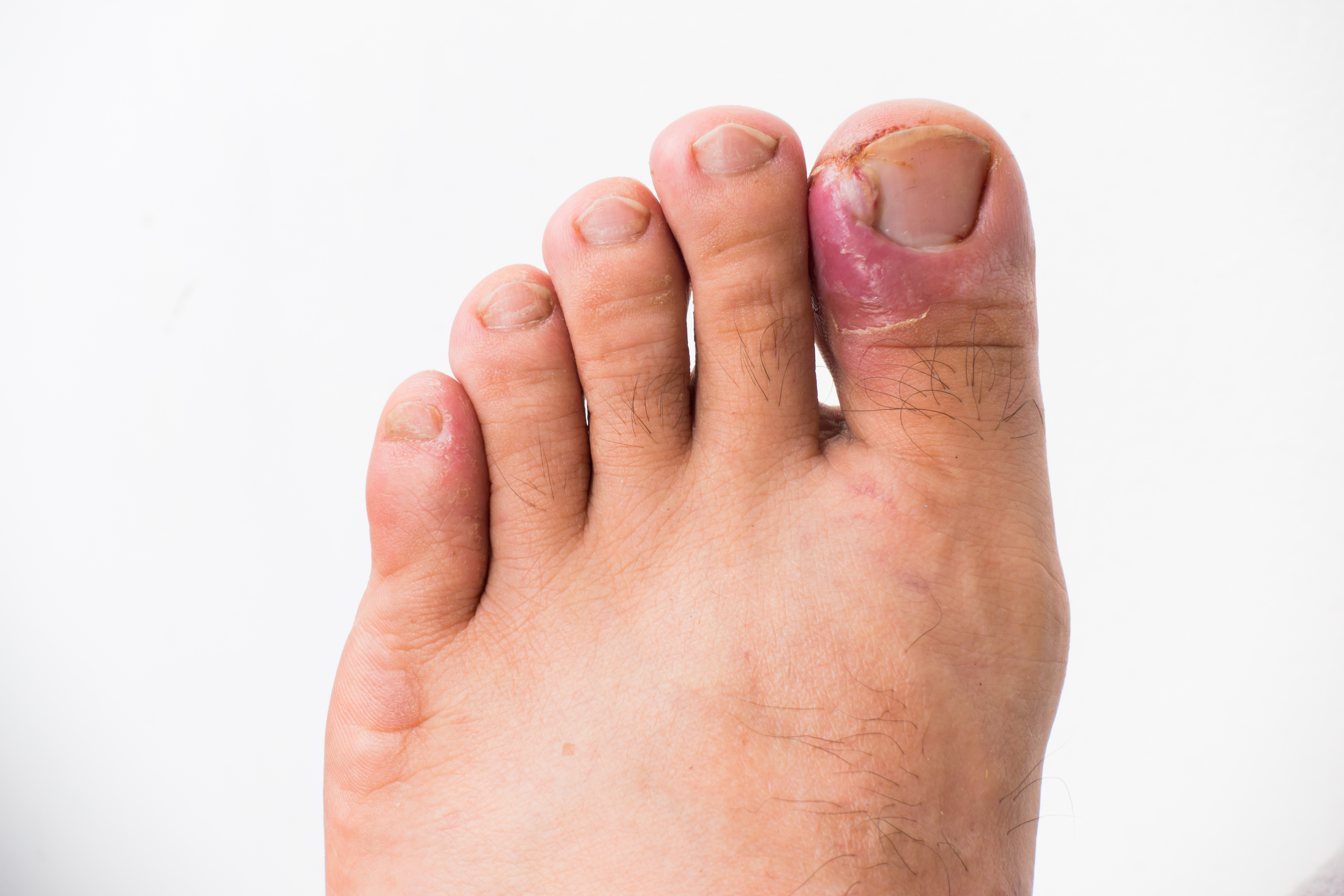 Ongle incarné infecté au gros orteil du pied