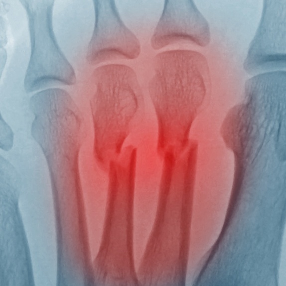 Radiographie des métatarses avec fractures