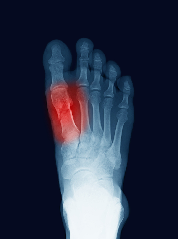 Radiographie d'un pied avec une fracture du premier métatarse
