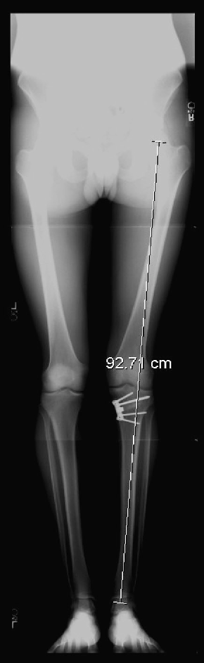 Radiographie des jambes pour déterminer la longueur de jambes