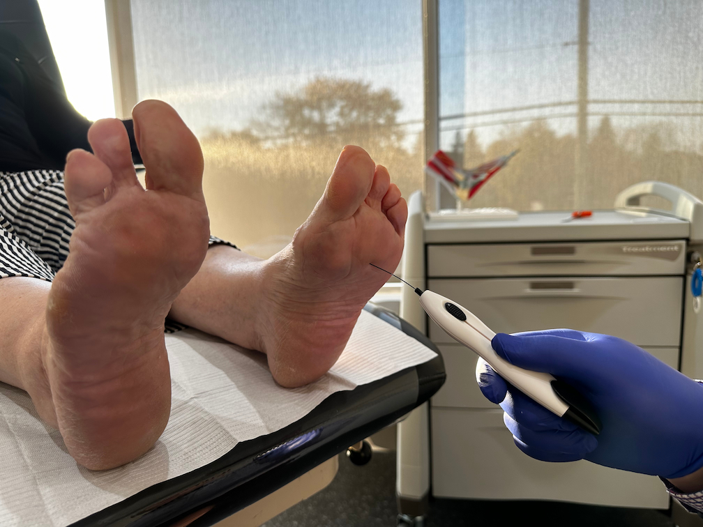 Examen par monofilament sous le pied d'un patient qui a été amputé des deux derniers orteils sur son autre pied