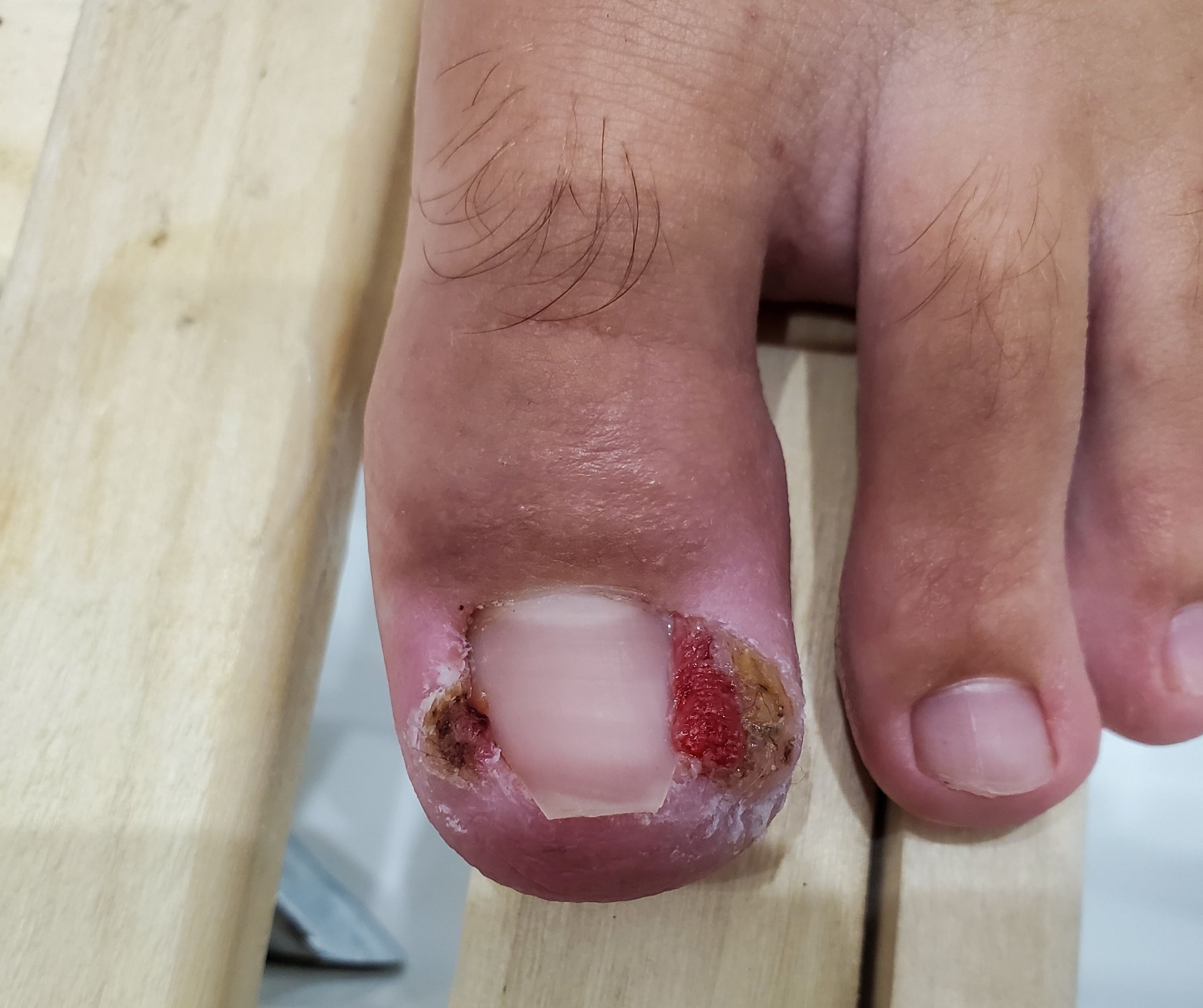Ongle du gros orteil avec présence de boule de chair