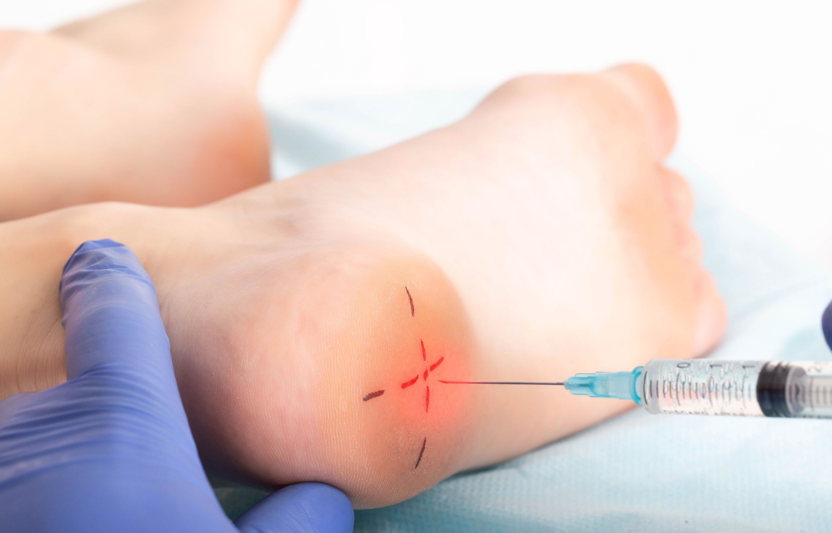 Infiltration de cortisone ciblée au niveau du talon d'un pied