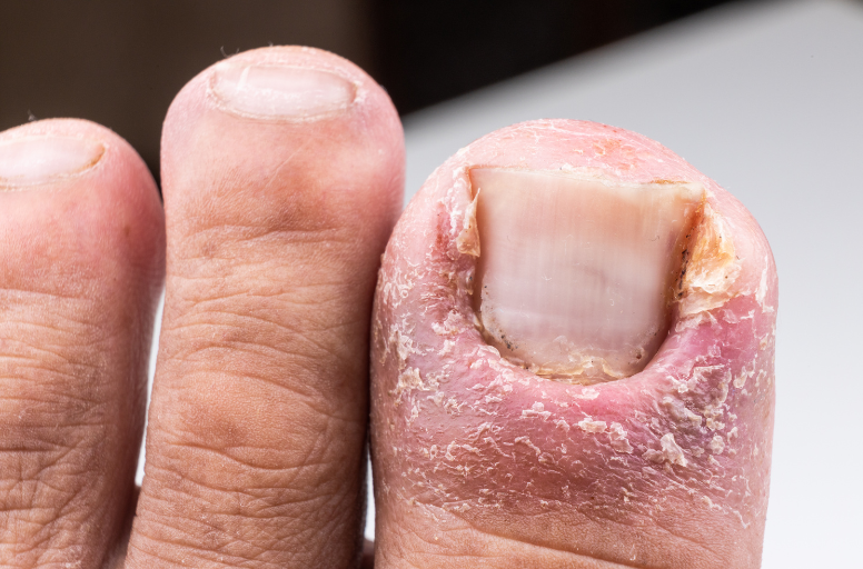 Ongle incarné sur un gros orteil