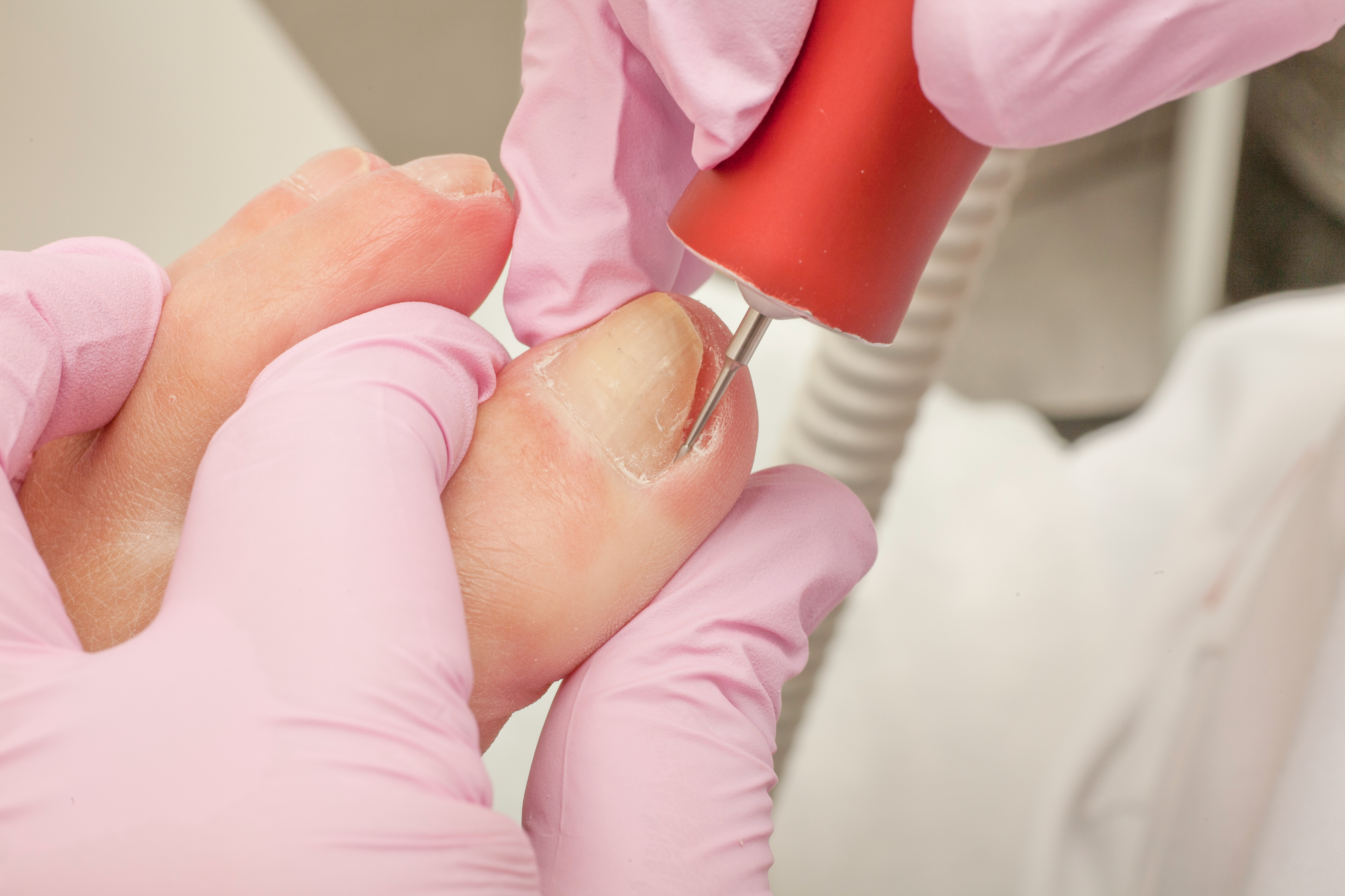 Dégagement d'un ongle incarné