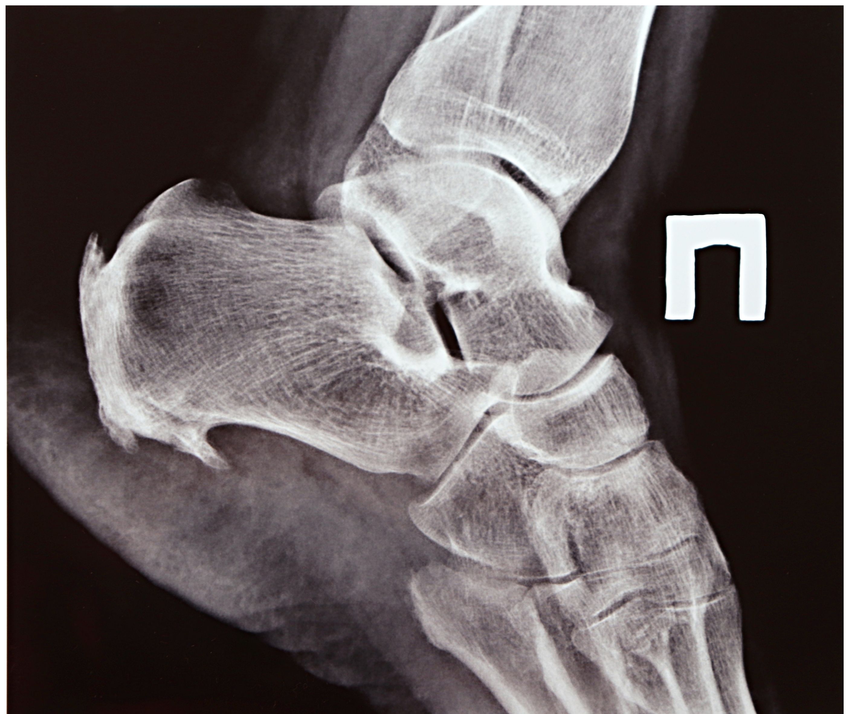 Radiographie d'un pied