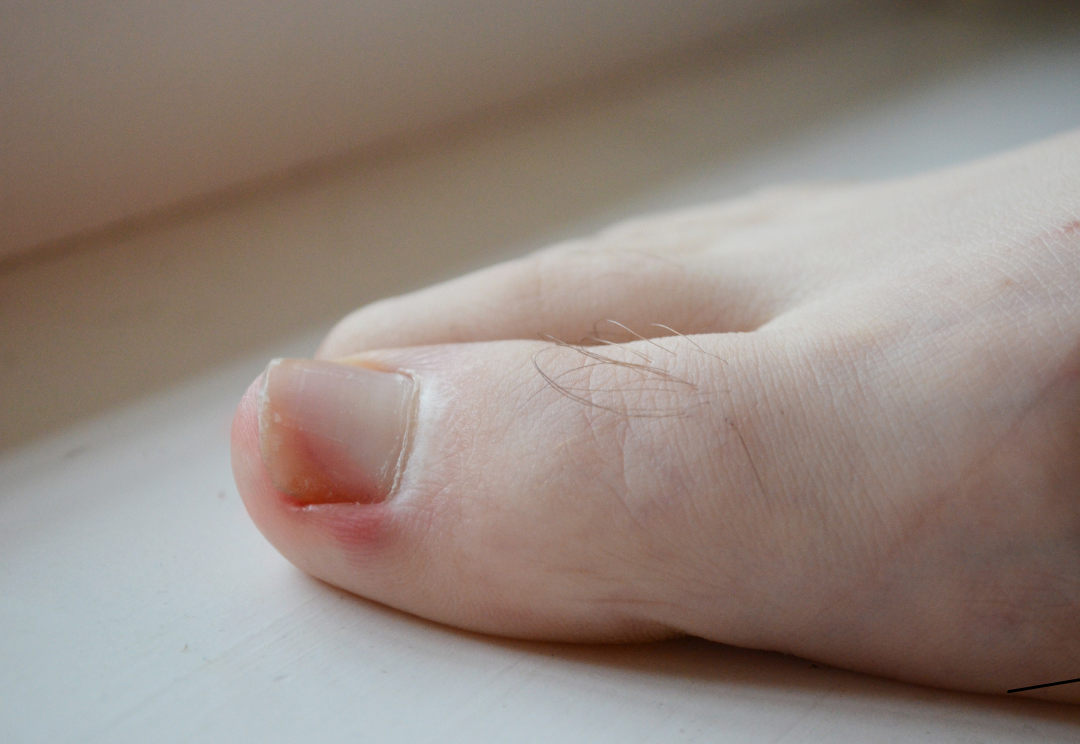 Petite rougeur autour de l'ongle d'orteil
