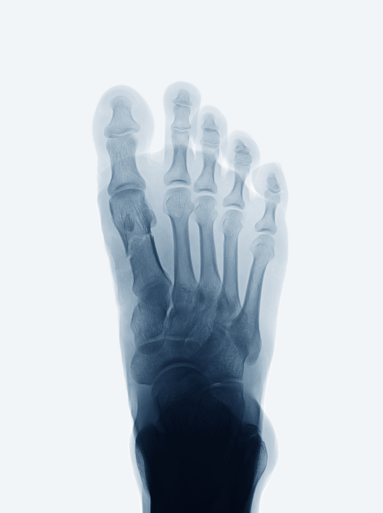 Radiographie d'un pied droit