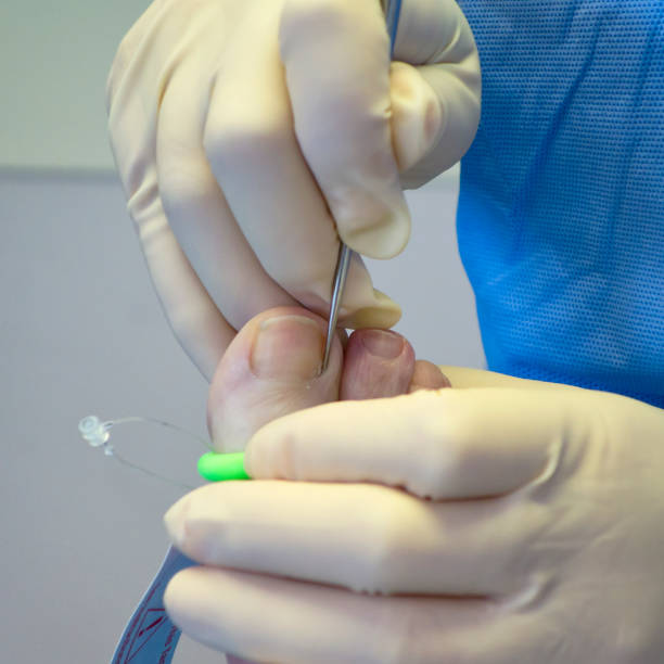 chirurgie d'un ongle incarné