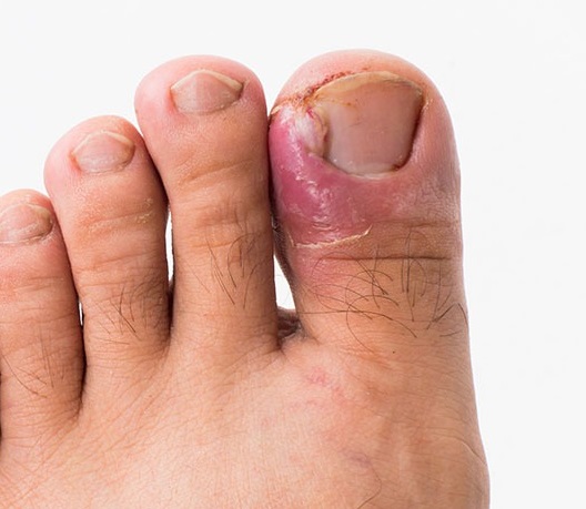 Ongle incarné sur un gros orteil