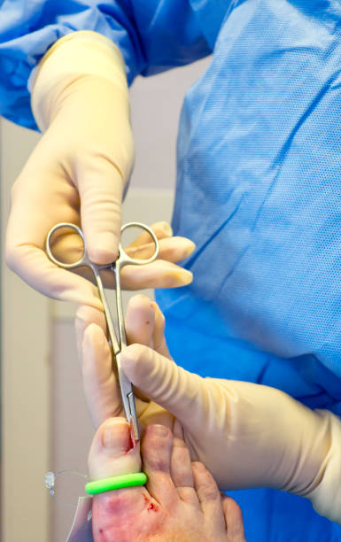 Chirurgie d'un ongle incarné par un podiatre sur un orteil