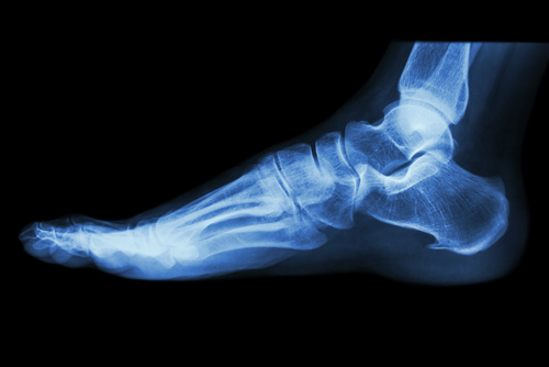 Radiographie d'un pied avec une épine de lenoir