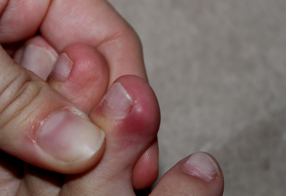 Ongle incarné sur un orteil